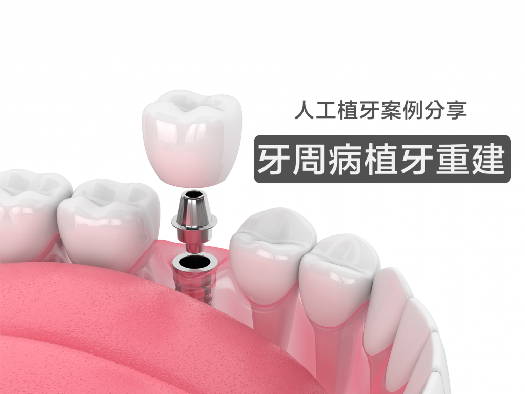 人工植牙案例分享-牙周病植牙重建